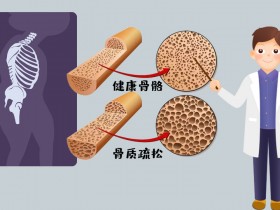为什么骨质疏松更偏爱女性？有2个原因！早知道早预防