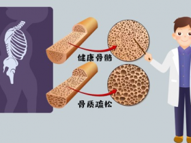 骨质疏松不是“老年人”的专利，40岁就要定期自查