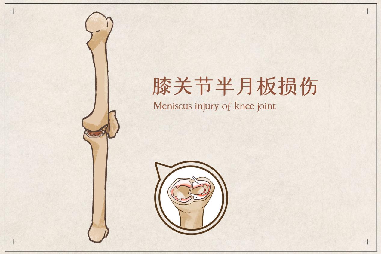 摄图网_401795628_banner_膝关节半月板损伤（非企业商用）