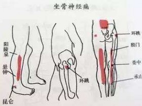 中医治疗坐骨神经痛的研究进展,坐骨神经痛的中医治疗方法