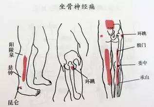 坐骨神经痛的主治穴位