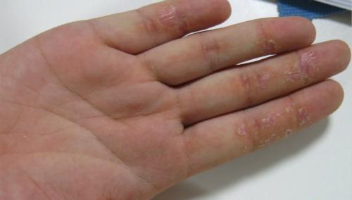 亚急性湿疹的偏方 亚急性湿疹的偏方