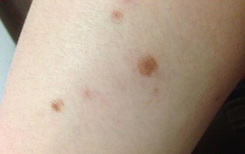 结节性痒疹的偏方 结节性痒疹的偏方