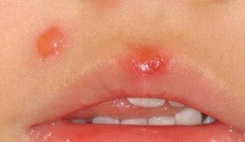 黄水疮的偏方 黄水疮的偏方