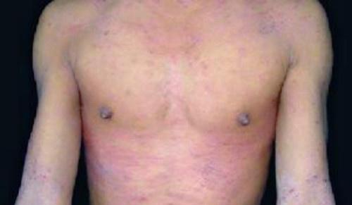 异位性皮炎的偏方2 异位性皮炎的偏方2