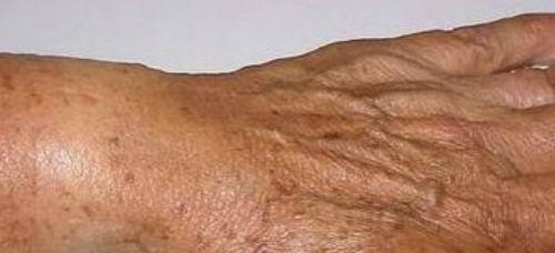 老年斑的偏方2 老年斑的偏方2