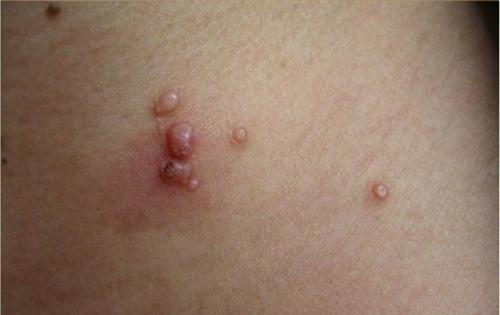 传染性软疣的偏方 传染性软疣的偏方