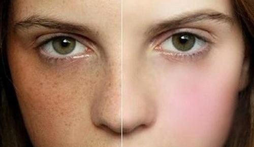 黄褐斑的偏方 黄褐斑的偏方