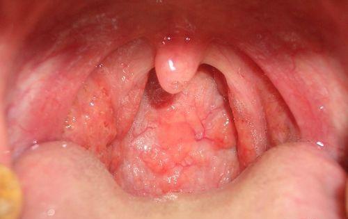 白喉的偏方 白喉的偏方