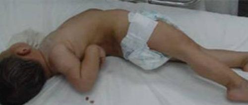 角弓反张的偏方2 角弓反张的偏方2