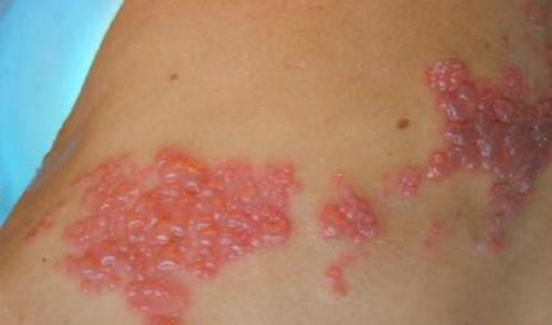 带状疱疹的偏方 带状疱疹的偏方