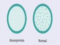 男人没有精子，还能当爹吗？