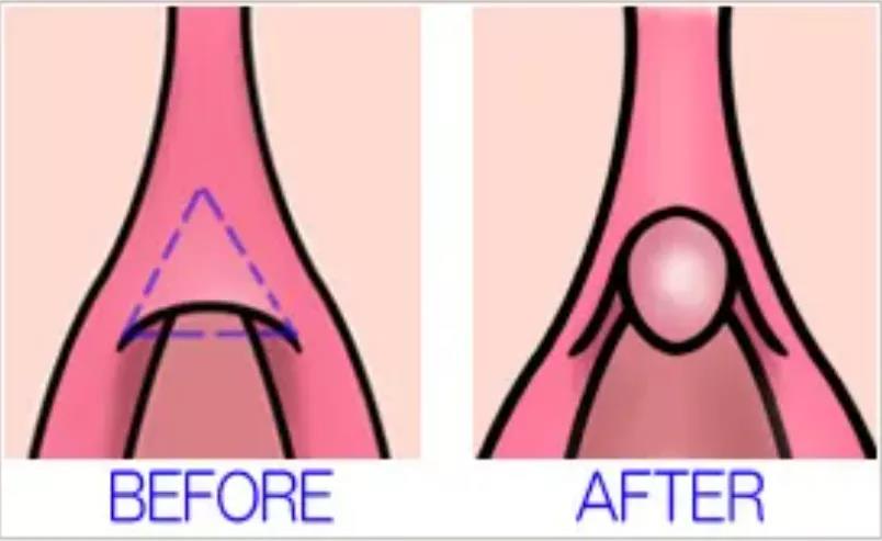 有包皮在保护着它