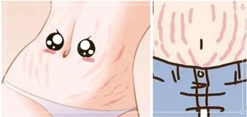 如何防止长妊娠纹