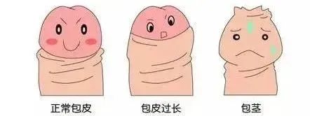 什么样的包皮需要割
