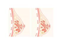 女生乳头凹陷是怎么回事