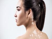 怎么治疗泛发型白癜风会好