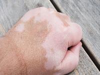 白癜风患者的饮食调理方法