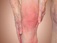 骨质增生x片膝关节