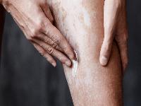 白癜风发病早期有什么症状