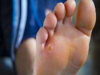 怎么看鸡眼是否去除