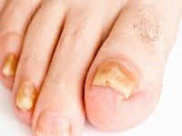 怎么看的没得灰指甲