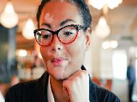 出现白癜风有什么危害吗