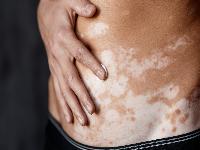 白癜风治疗该怎么办好呢