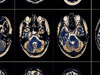 白天好到晚上头疼怎么了，怎么办？