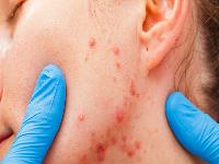 艾滋病患者护理注意事项