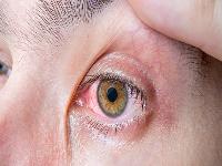 药物副作用引起的干眼症